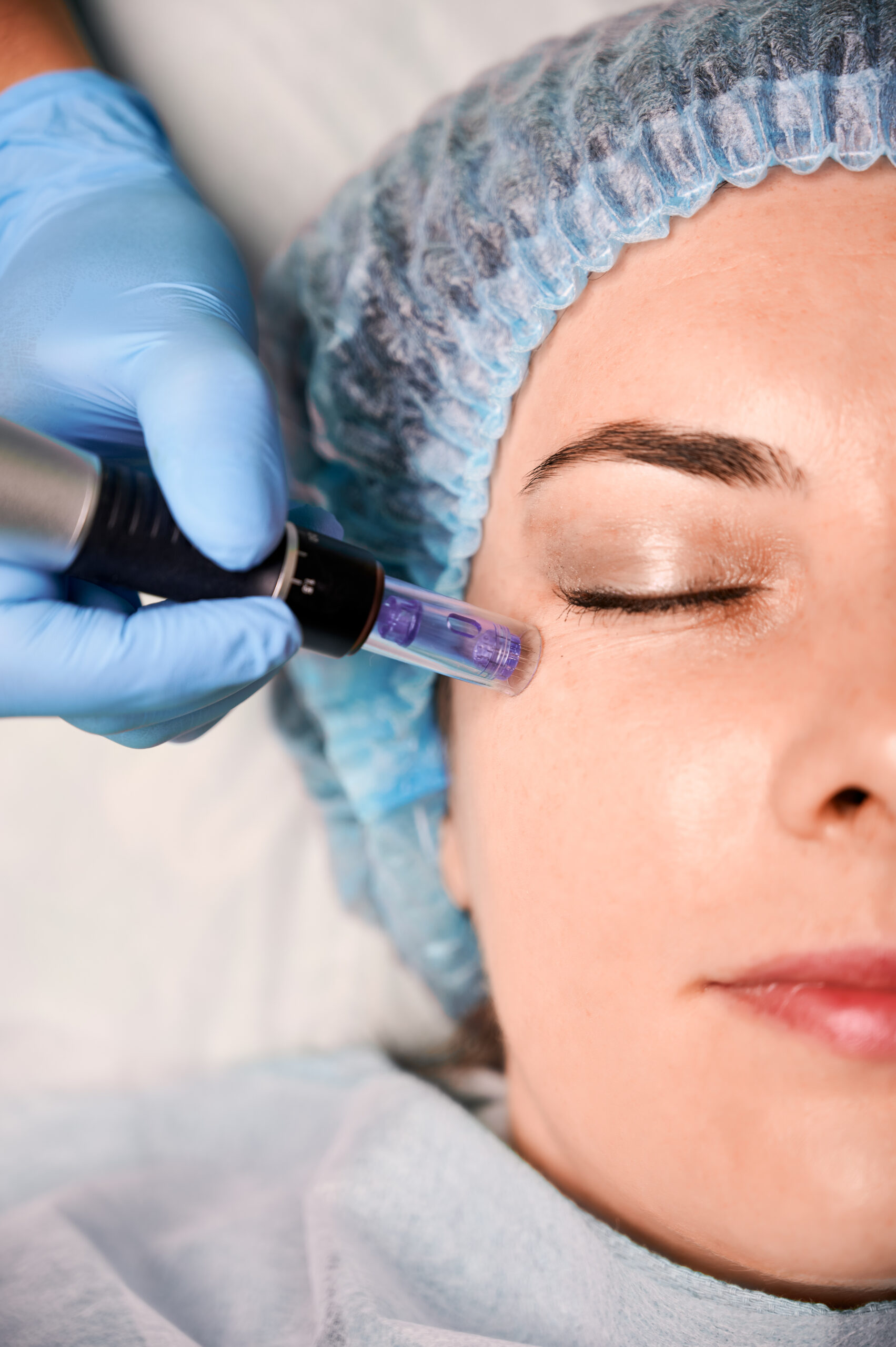 female client having fractional mesotherapy beauty salon scaled